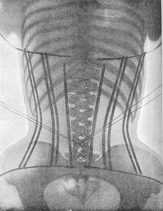 X-ray image (back view) of a woman wearing a corset from the second volume of the French doctor Ludovic O'Followell's Le Corset (1908). Although Dr O'Followell was clearly keen to show the damaging impact of corsets on women's health, he did not actually want the corset to be abolished, but was simply trying to encourage a less severe design. Dr O'Followell in fact continued to write a regular column for the deluxe corsetier's magazine Les Dessous Elegance. AKG5464527 © akg-images / Science Source X-ray image (back view) of a woman wearing a corset from the second volume of the French doctor Ludovic O'Followell's Le Corset (1908). Although Dr O'Followell was clearly keen to show the damaging impact of corsets on women's health, he did not actually want the corset to be abolished, but was simply trying to encourage a less severe design. Dr O'Followell in fact continued to write a regular column for the deluxe corsetier's magazine Les Dessous Elegance. AKG5464527 © akg-images / Science Source