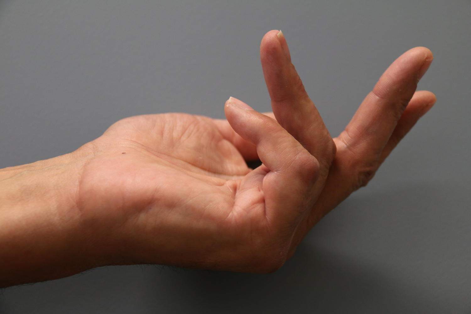 Bij de ziekte van Dupuytren trekken de vingers krom, doordat er harde strengen bindweefsel in de handpalm ontstaan.  / © UZ Leuven