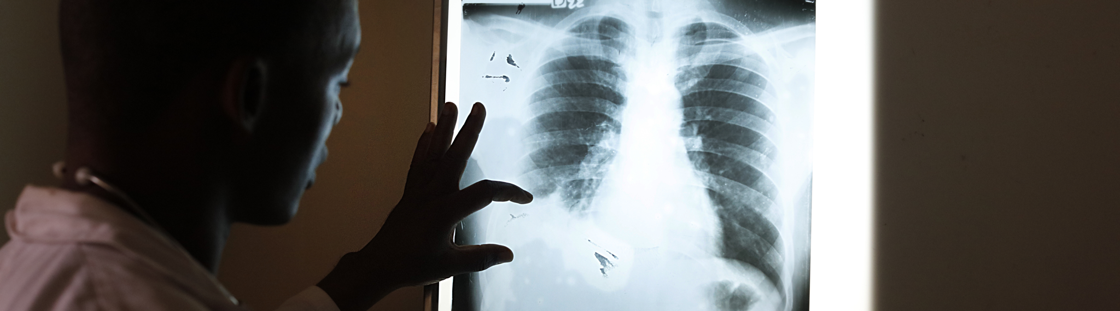 Damiaanactie dringt aan op betere toegang tot gezondheidszorg voor tuberculosepatiënten, ook in België