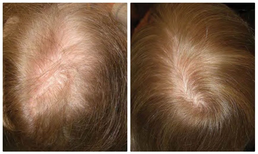 Before and after usage of Mayraki Professional Hair Regrowth Ulti-Nutra Laser System