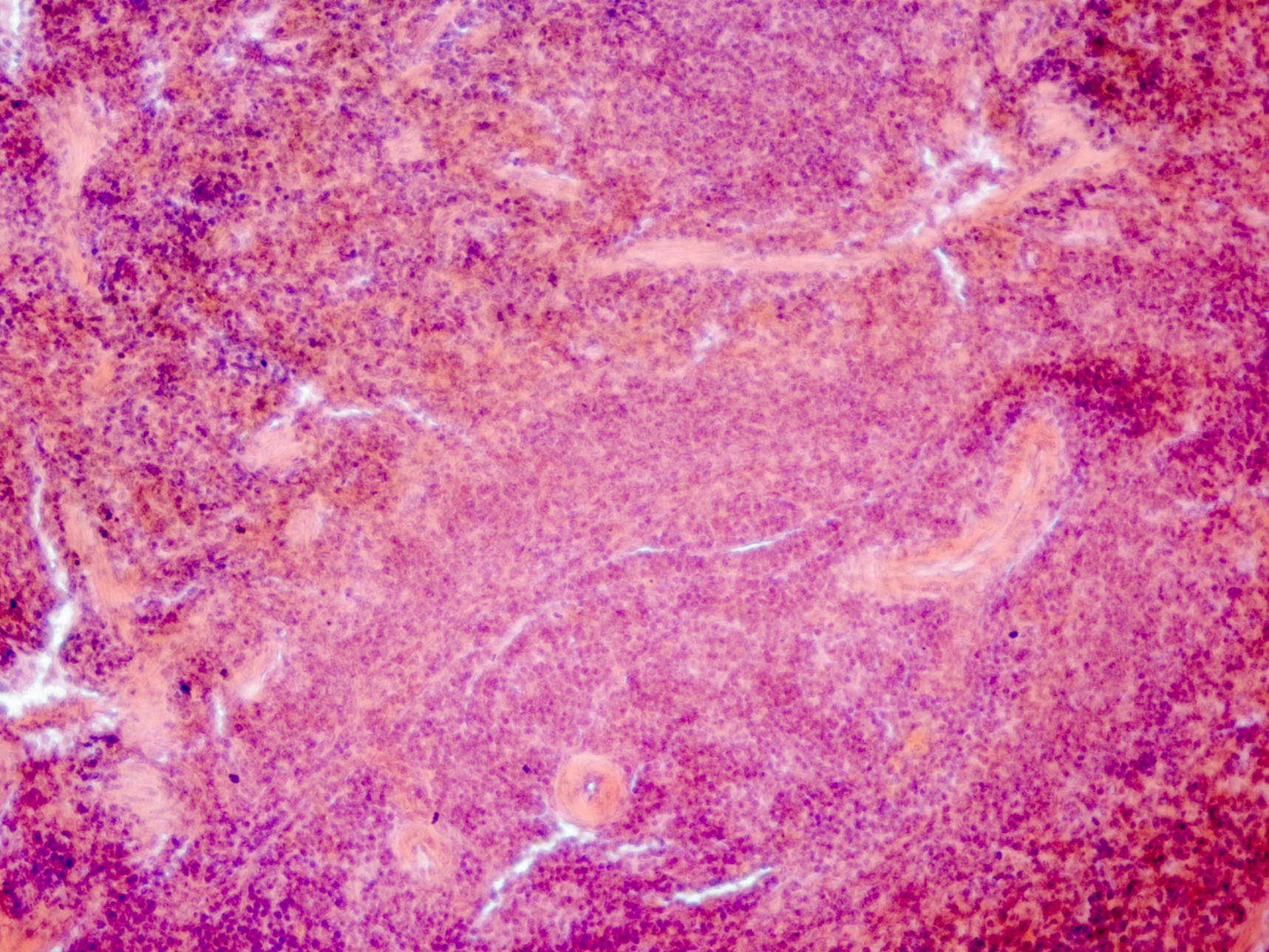 Researchers identify a key metabolic gene as target for improved cancer immunotherapy