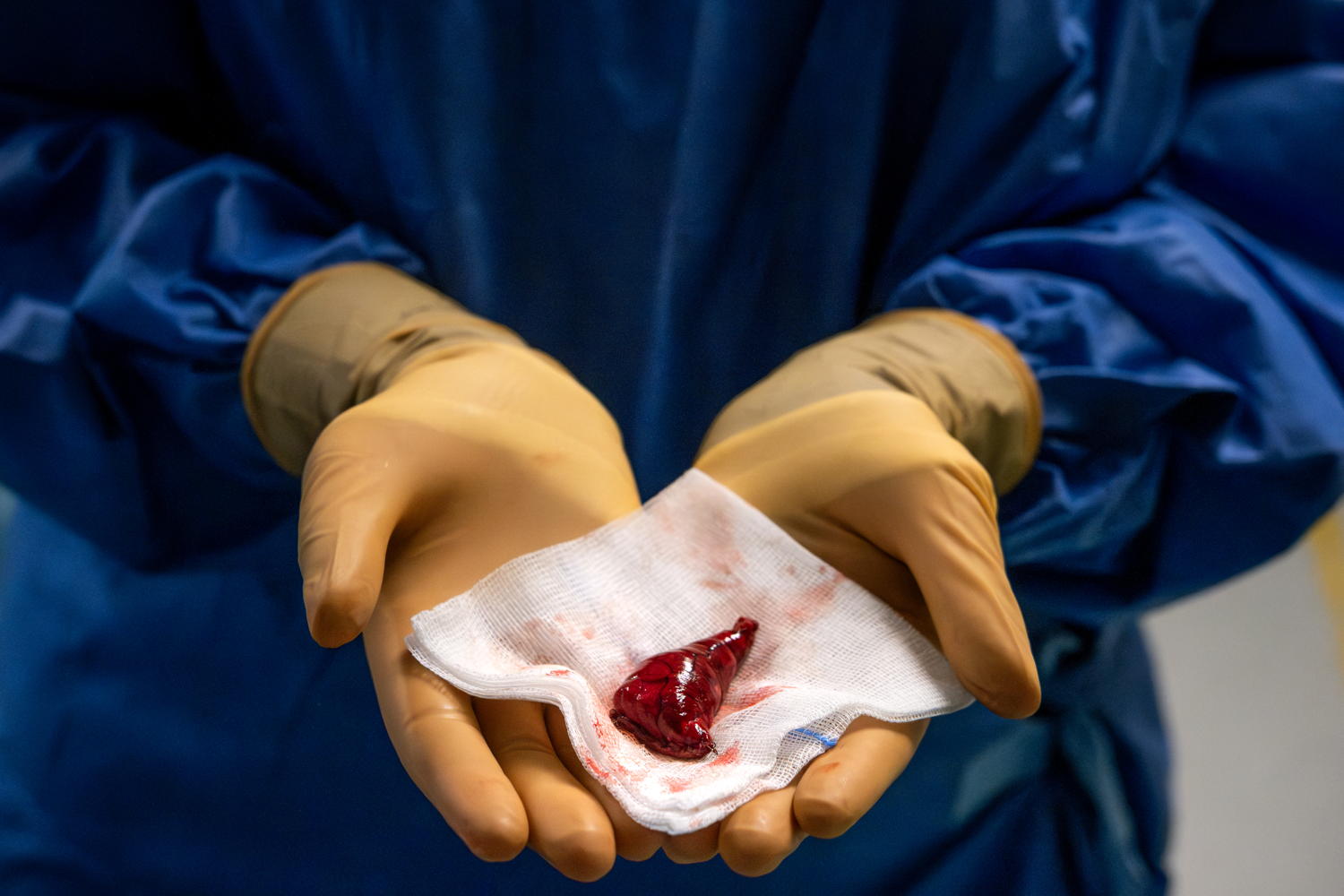 Een longtumor die werd verwijderd met een operatie. (Foto: ZAS - Sara Van Daele)