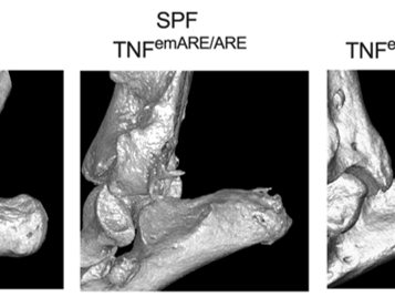Untangling gut and joint inflammation in arthritis 