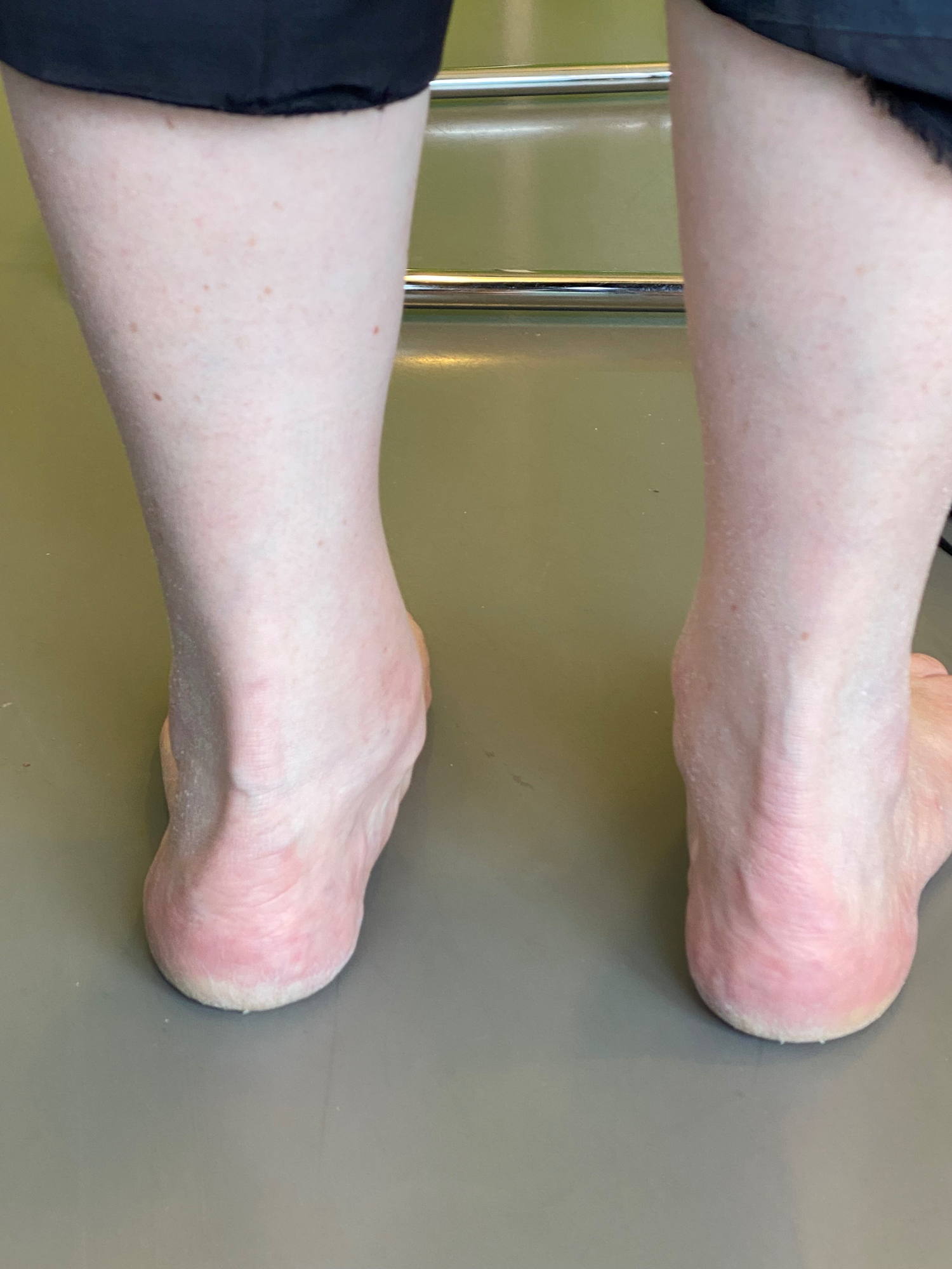 Een patiënt met een pathologische (ongezonde) platvoet. 