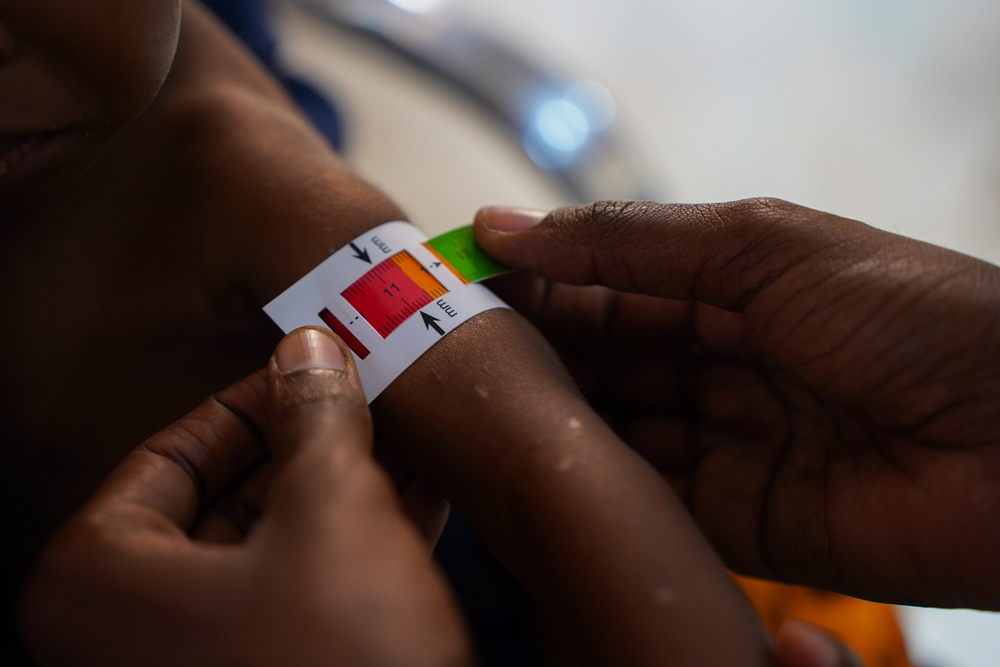 Niño con desnutrición en Baidoa, Somalia. Junio 2024. BISHAR MAYOW/MSF