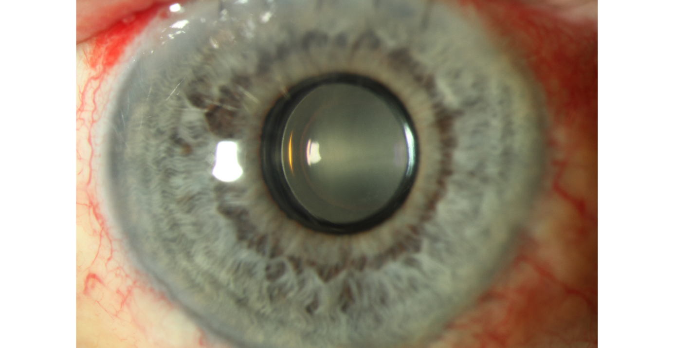 Œil avec lentille implantée
