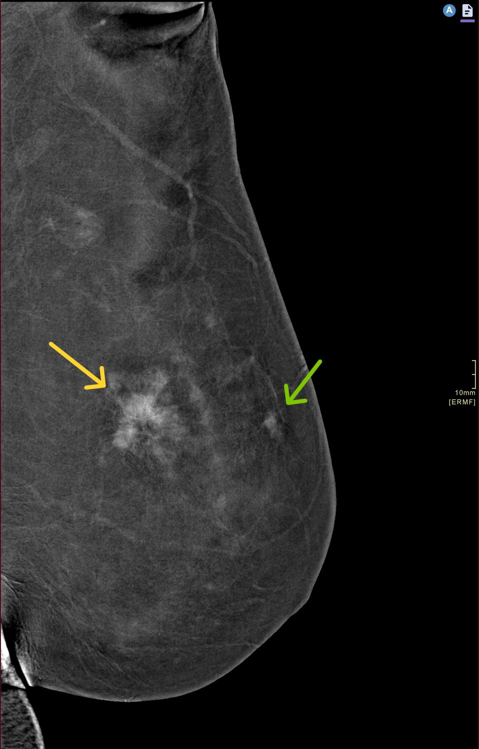 Voorbeeld van een contrastmammografie. De tumor (gele pijl) en een kleinere bijkomende tumor vooraan in de borst (groene pijl) zijn duidelijk waarneembaar. © GZA Ziekenhuizen