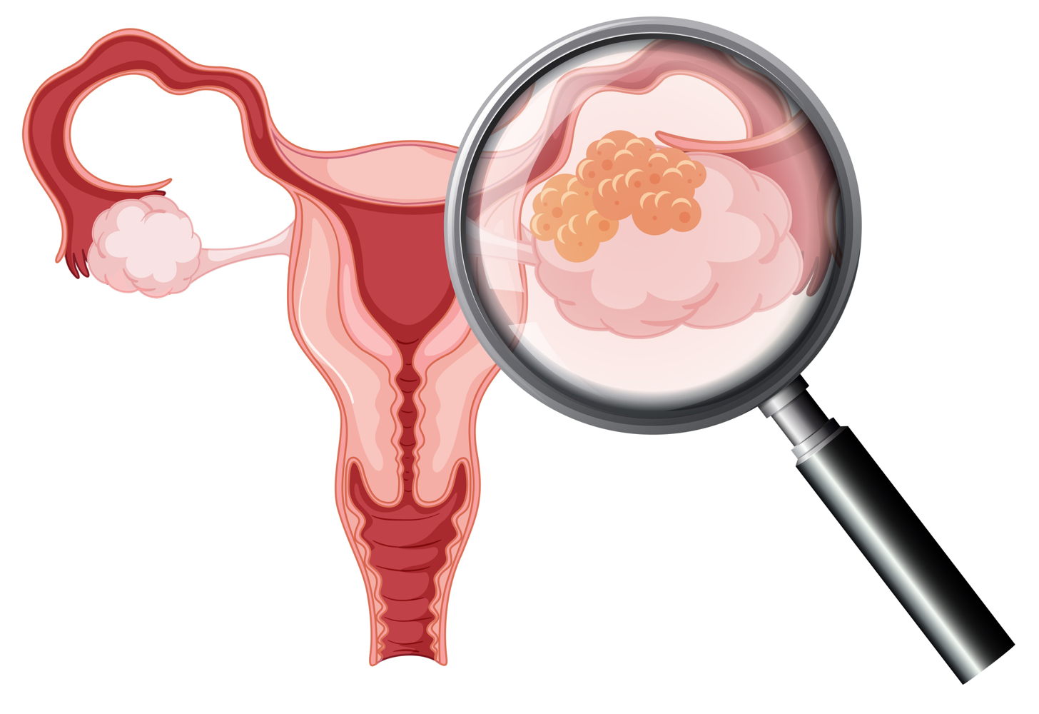 Eierstokkanker (© Shutterstock)