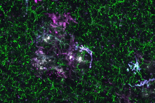 Different human microglia engrafted in a mouse brain.
