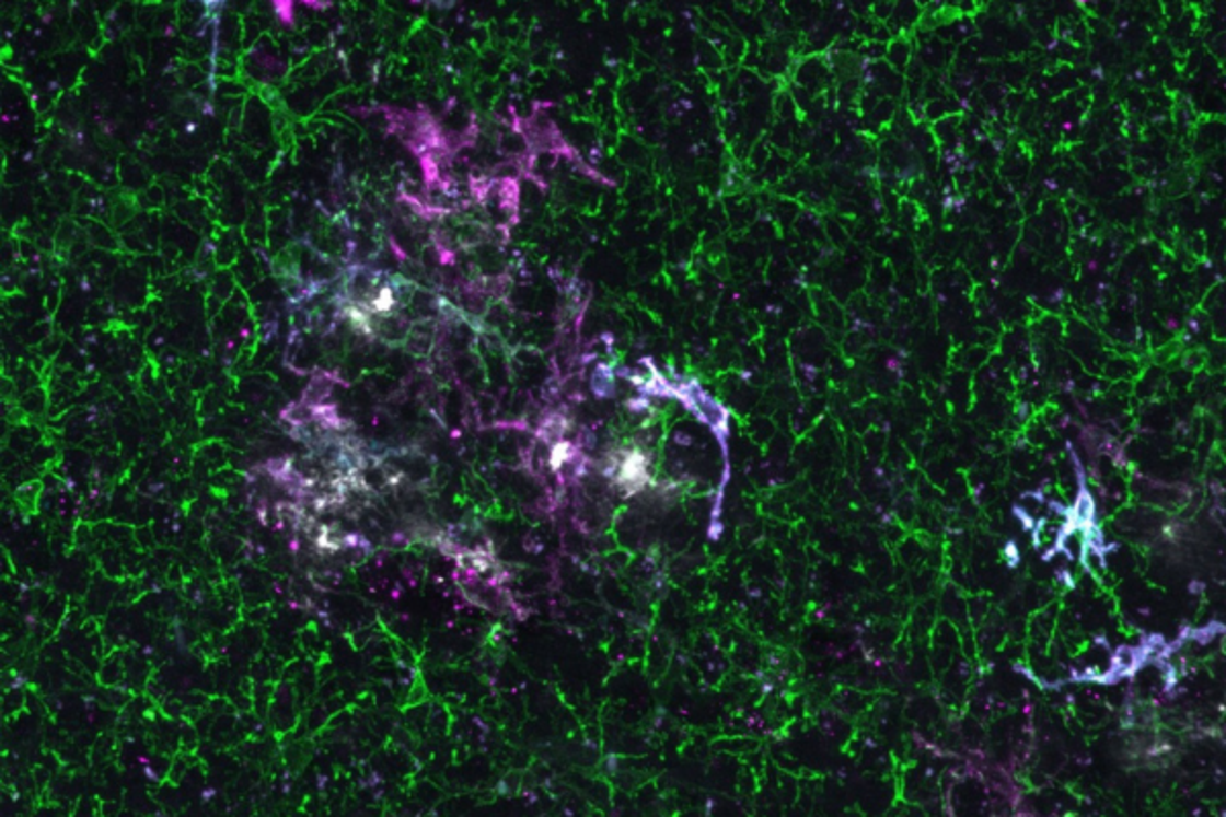 Understanding the role of microglia in Alzheimer’s disease