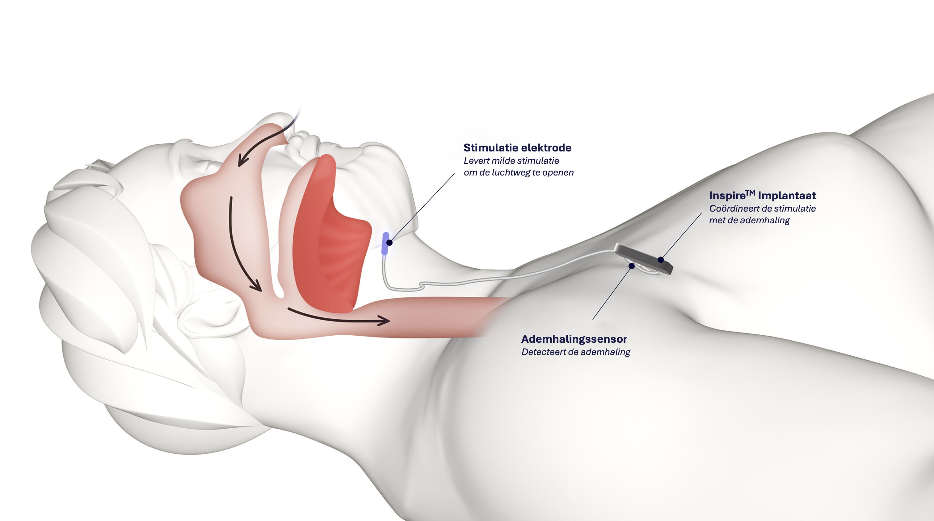 Een cuff om de tongzenuw (blauw) wordt onder de huid verbonden aan een stimulator tussen sleutelbeen en borststreek. Vanuit de stimulator loopt een draadje naar de long toe. Hieraan zit een sensor. Die sensor geeft een signaal bij inademen naar de stimulator, die vervolgens de tongzenuw stimuleert om de ruimte achteraan de keel te vergroten en de slaapapneu te bestrijden.