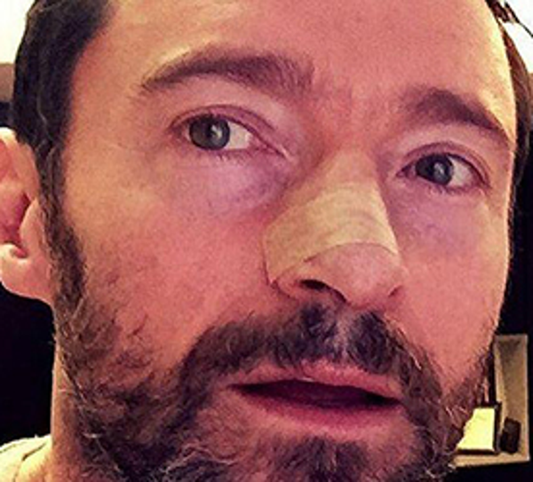 How Hugh Jackman and Others Could Prevent Skin Cancers