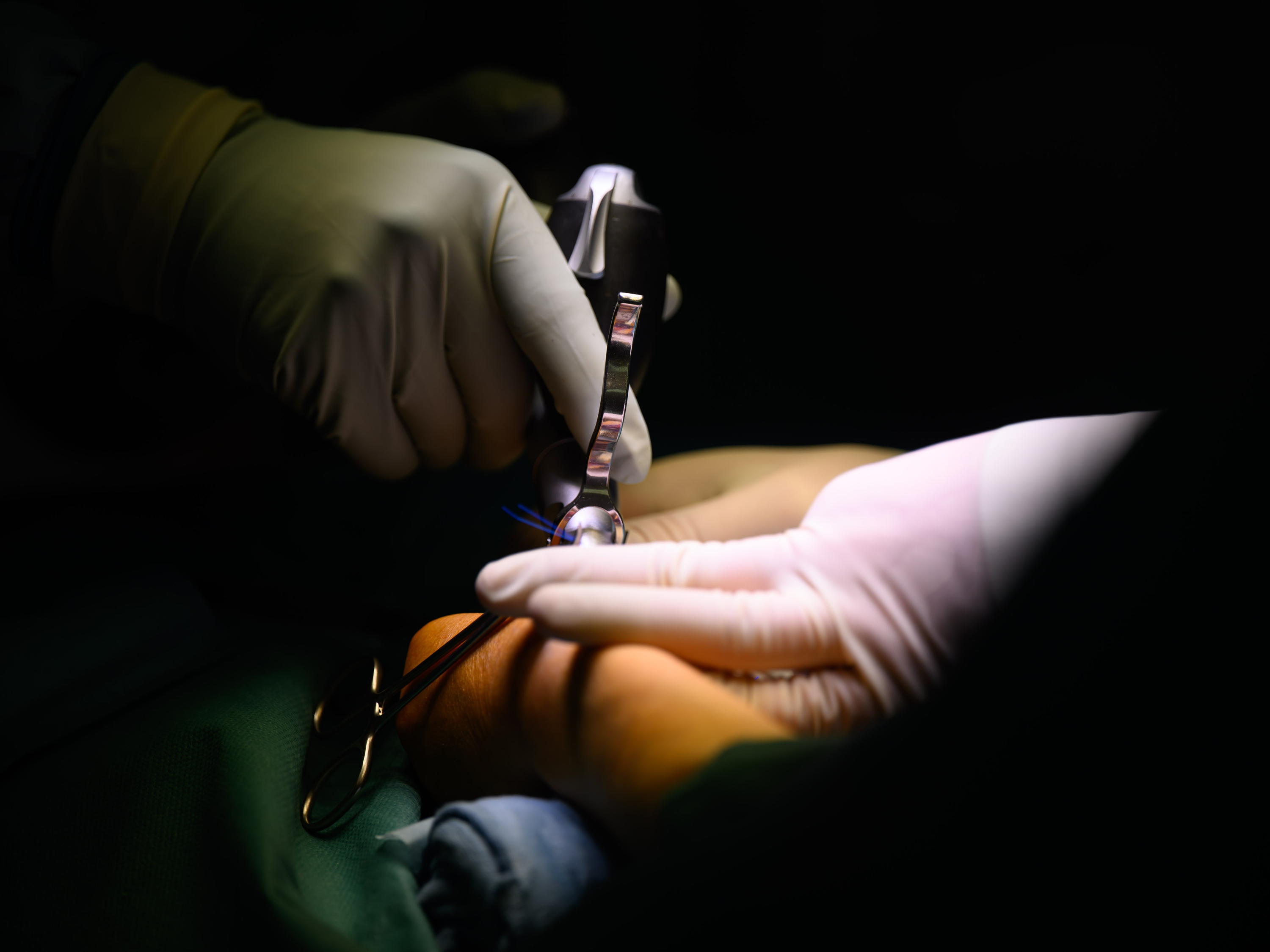 US surgeons visit Belgian hospitals to gain expertise in thumb prosthetics