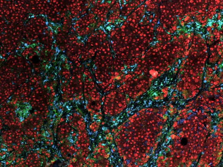 Onderzoekers brengen samenstelling van melanoomtumoren in kaart en identificeren oorzaak van weerstand tegen immunotherapie