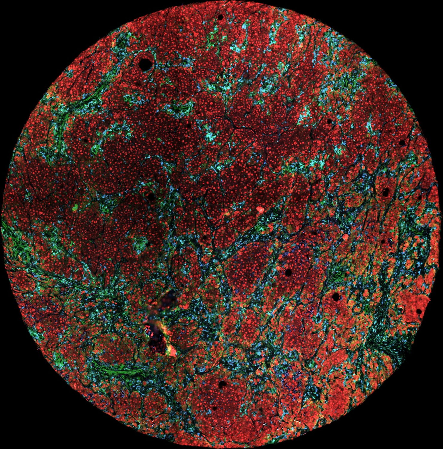 Microscopy image of human melanoma cells
