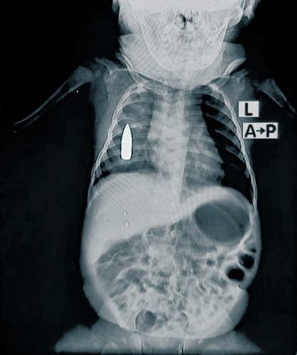 XRay of Baby Riyad. The 18-month-old toddler was struck in the chest by a stray bullet while he was taking a nap in Khartoum. 07 November, 2024. Copyright: MSF 