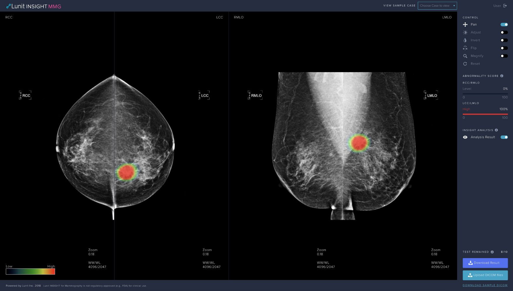 ▲ Lunit INSIGHT MMG, AI solution for breast cancer detection from mammograms