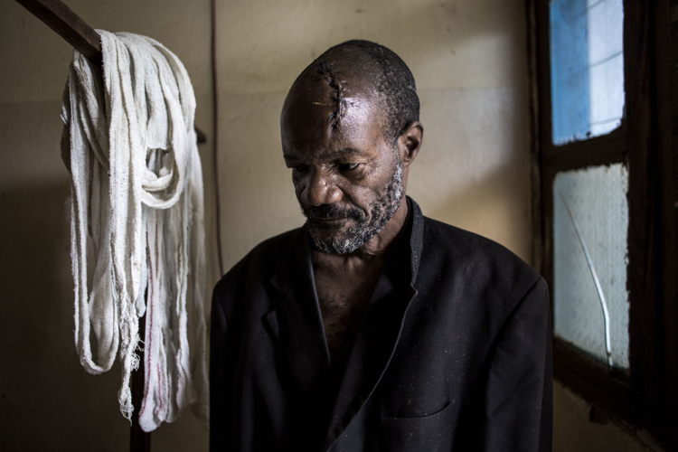 Bawma Yoame (56), recovers in a hospital room on 2 March 2018 in Bunia, after an attack on his village left him severely wounded with multiple lacerations to the head. Fighting in Ituri province has left thousands of Congolese displaced and some 100 have lost their lives. PHOTO/JOHN WESSELS Bawma Yoame (56), recovers in a hospital room on 2 March 2018 in Bunia, after an attack on his village left him severely wounded with multiple lacerations to the head. Fighting in Ituri province has left thousands of Congolese displaced and some 100 have lost their lives. PHOTO/JOHN WESSELS