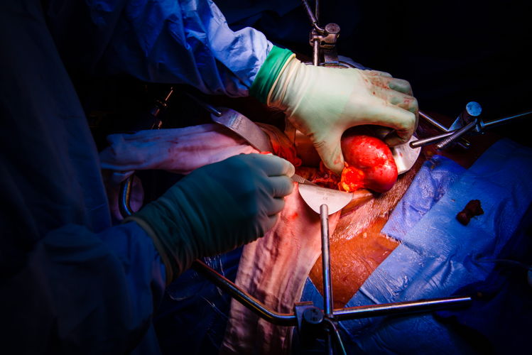 Niertransplantatie (UZ Leuven)