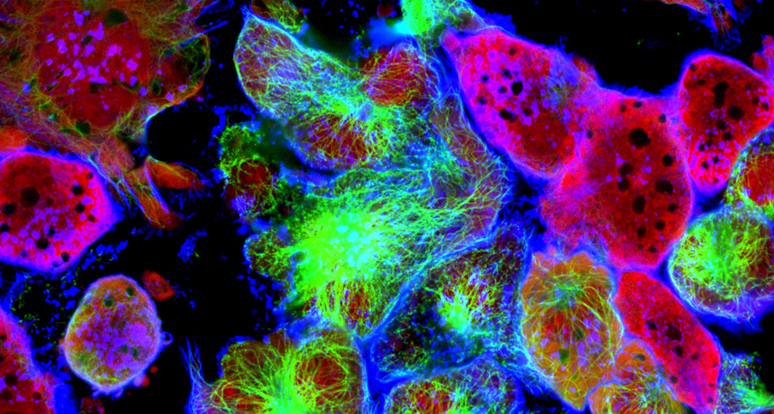 Onderzoekers ontdekken waarom regulatoire T-cellen bij kanker het immuunsysteem onderdrukken