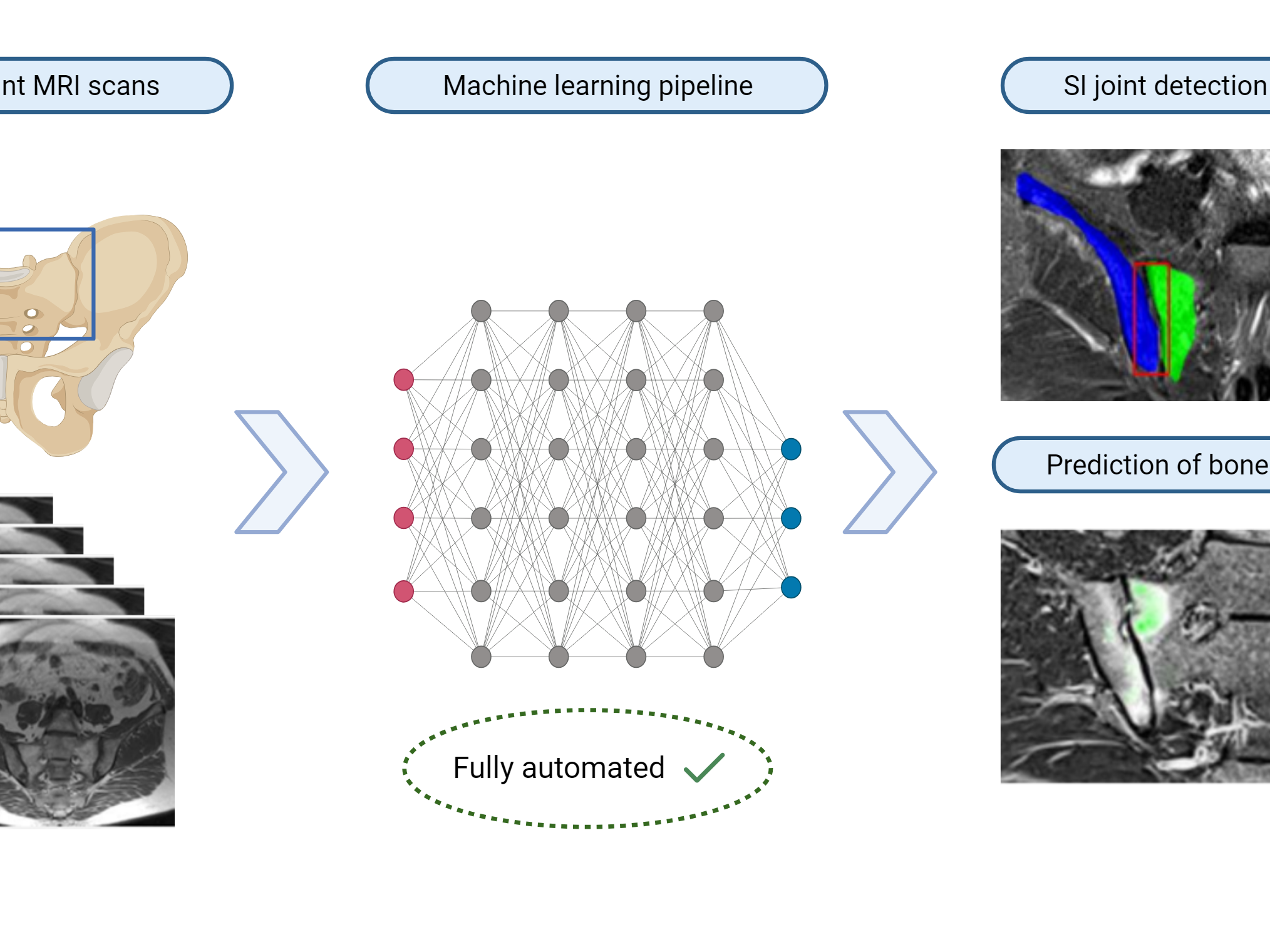 AI assists in arthritis diagnosis based on MRI images 
