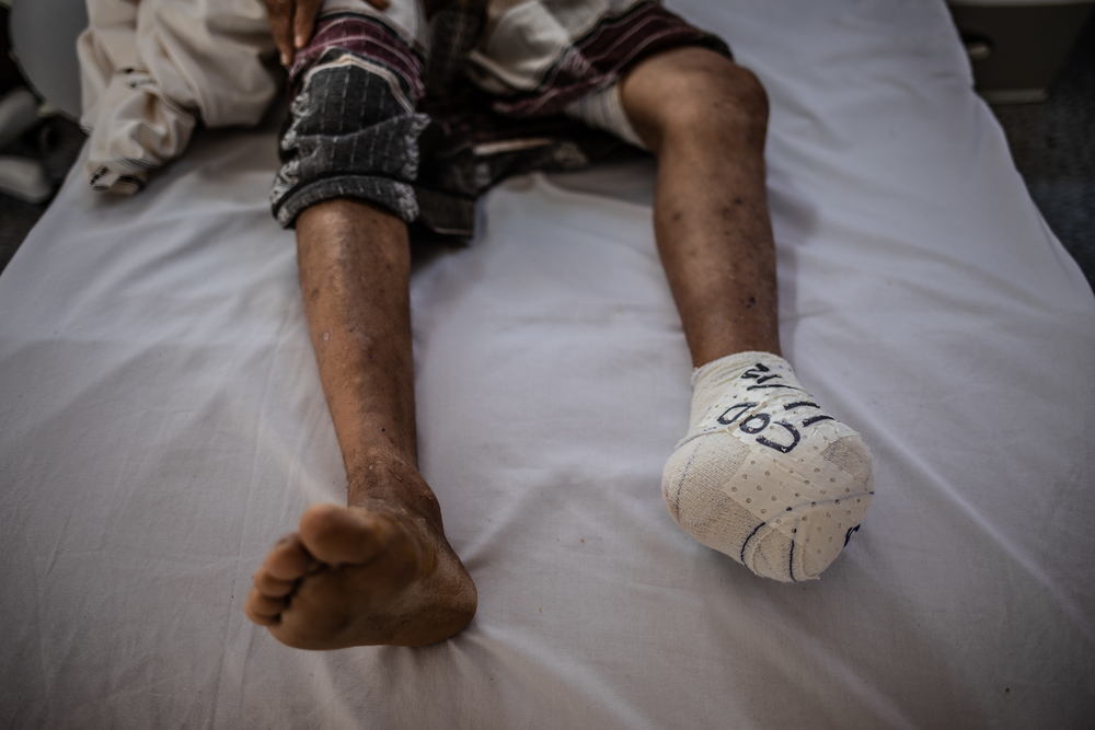 Une personne amputée, prise en charge par MSF à Moche © MSF