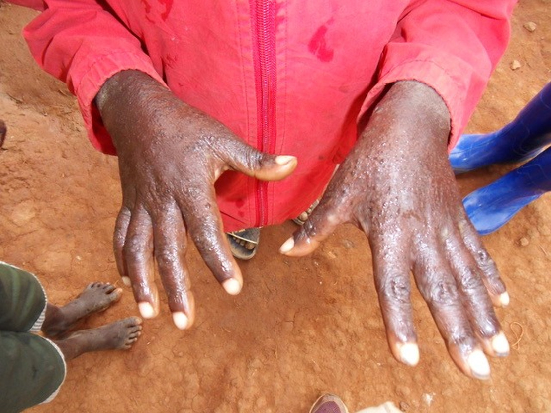 Treating scabies – a forgotten disease in a forgotten corner of the world