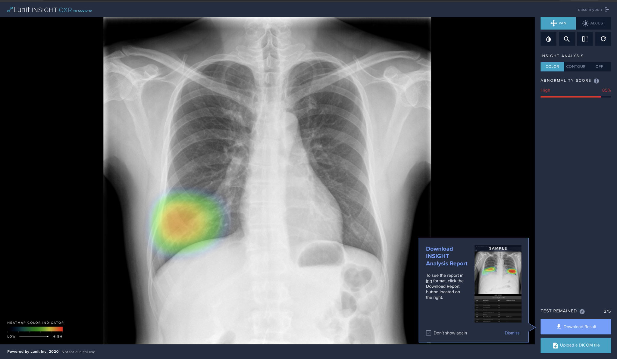 A screenshot of Lunit INSIGHT CXR for COVID-19 analyzing a lung consolidation case. In light of the outbreak, the service is currently provided online for free.