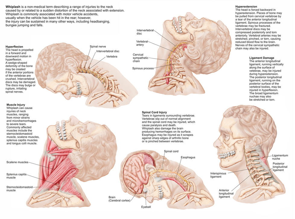 Medical chart showing the range of injuries to the human neck caused by whiplash. AKG4521643 © akg-images / Stocktrek Images