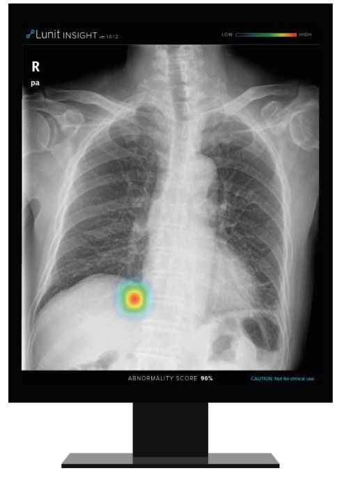 Lunit INSIGHT CXR detects findings and provides abnormality score on a chest X-ray image