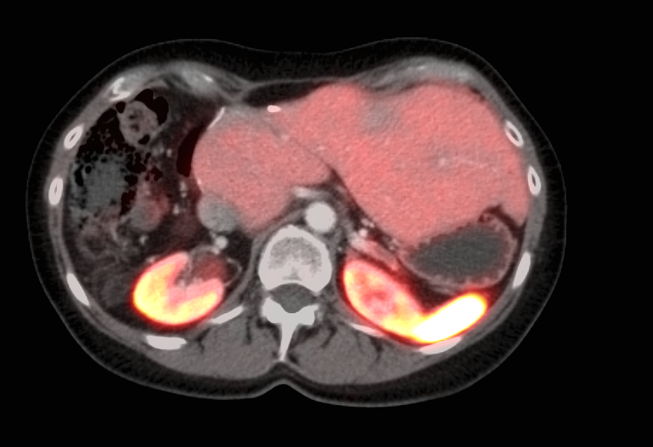 Na therapie met het lutetium-177 bevattend geneesmiddel
