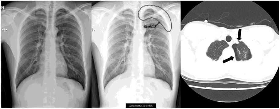 ▲ Lunit INSIGHT CXR marks the location and probability of an abnormal finding on chest radiograph