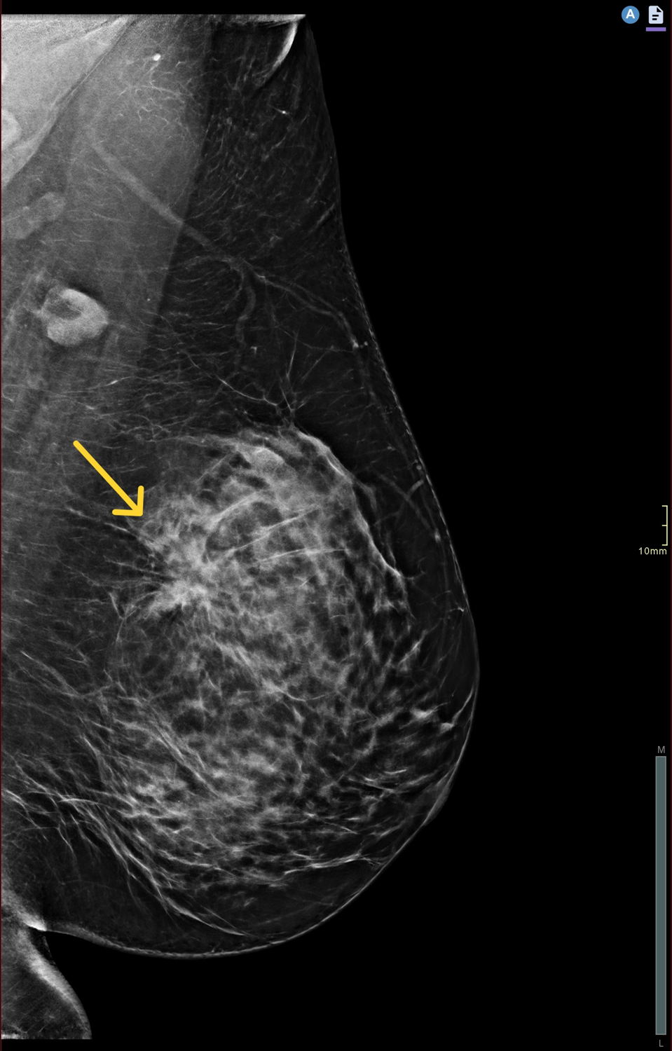 Ter vergelijking: een klassieke mammografie van dezelfde borst. Door het dichte klierweefsel is de tumor (gele pijl) minder goed zichtbaar. De bijkomende tumor is hier zelfs niet zichtbaar. © GZA Ziekenhuizen