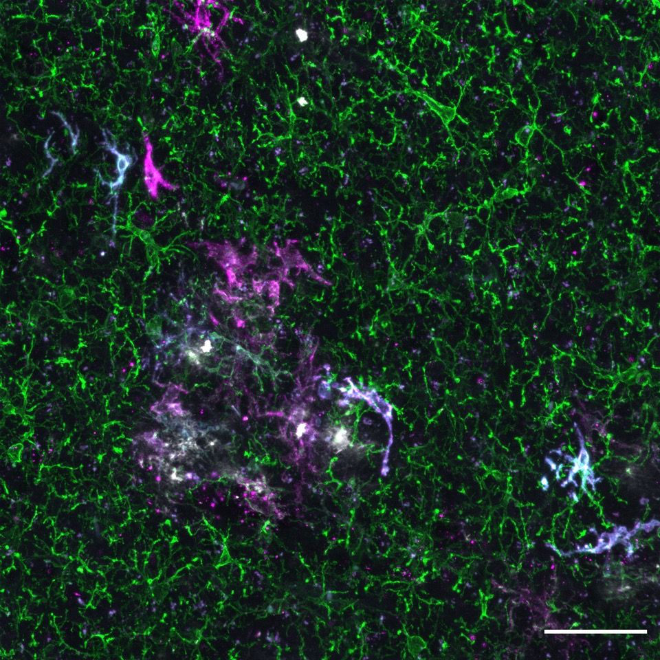 Different human microglia engrafted in a mouse brain.