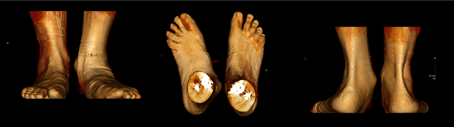 De virtuele reconstructie van de voet op de foto op basis van een CT-scan waarbij de patiënt rechtstaat.
