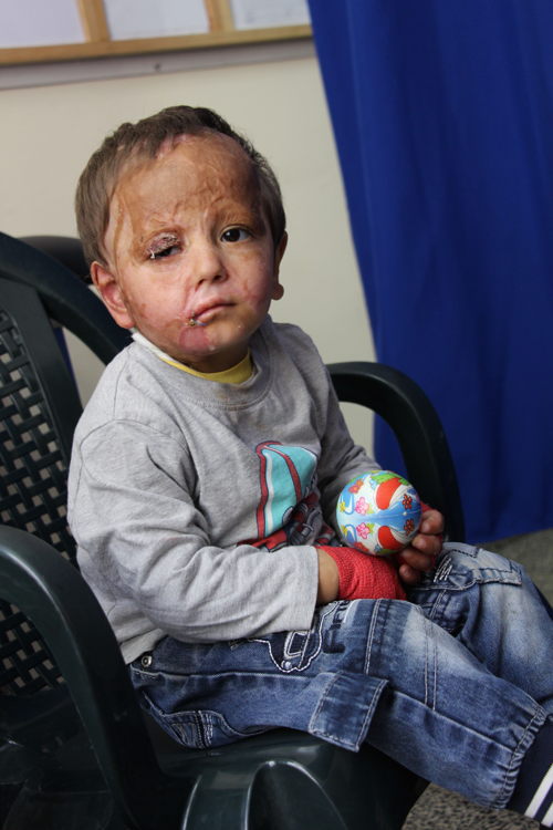 Mohammad 3 years old and his grandmother at Khan Younis clinic for dressing care and physio, follow up on severe burns injuries, domestic accident, a neighbour threw boiling oil out of the window and the little boy was outside. First at Nasser Hospital where he was immediately transferred to the ICU and then they transferred him to Jerusalem where he got some skin grafts. And after coming back from Israel we came with him to the MSF clinic in Khan Younis, and was taken care of the team. He was also in surgery in the MSF surgical round in April 2015. The MSF surgical team operated on his upper eye lid, his right arm, and for the mouth opening. We are now regularly in the MSF clinic for physiotherapy, dressing care, burn rehabilitation, because he just came out of surgery. © Susanne Doettling/MSF Mohammad 3 years old and his grandmother at Khan Younis clinic for dressing care and physio, follow up on severe burns injuries, domestic accident, a neighbour threw boiling oil out of the window and the little boy was outside. First at Nasser Hospital where he was immediately transferred to the ICU and then they transferred him to Jerusalem where he got some skin grafts. And after coming back from Israel we came with him to the MSF clinic in Khan Younis, and was taken care of the team. He was also in surgery in the MSF surgical round in April 2015. The MSF surgical team operated on his upper eye lid, his right arm, and for the mouth opening. We are now regularly in the MSF clinic for physiotherapy, dressing care, burn rehabilitation, because he just came out of surgery. © Susanne Doettling/MSF