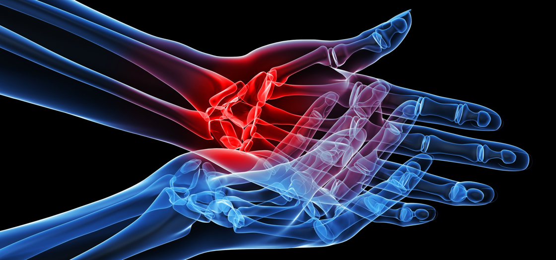 Erosion blockade breakthrough: clinical trial signals hope for hand osteoarthritis