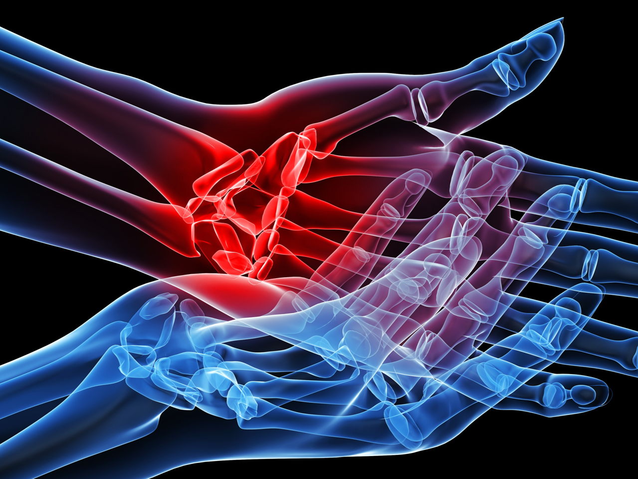 Erosion blockade breakthrough: clinical trial signals hope for hand osteoarthritis