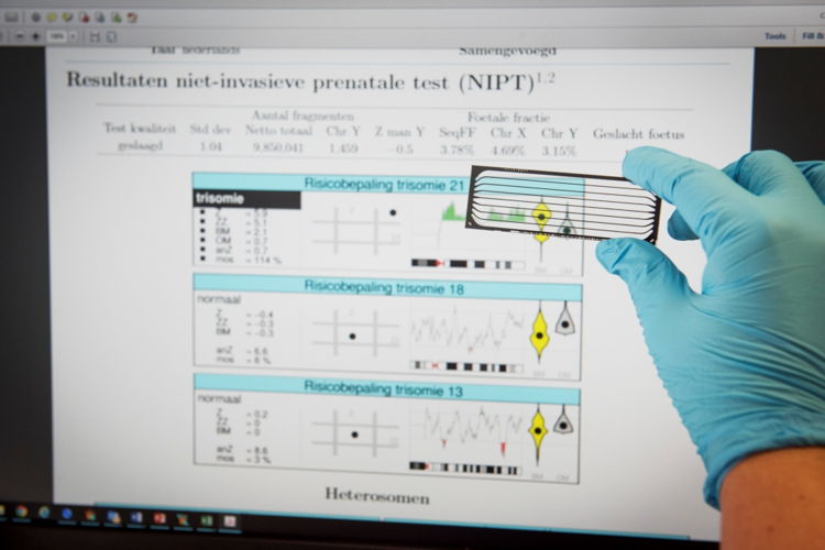 Het resultaat van een NIPT (UZ Leuven)