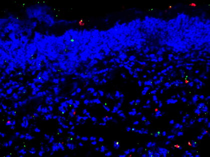 Speeding up diabetic wound healing