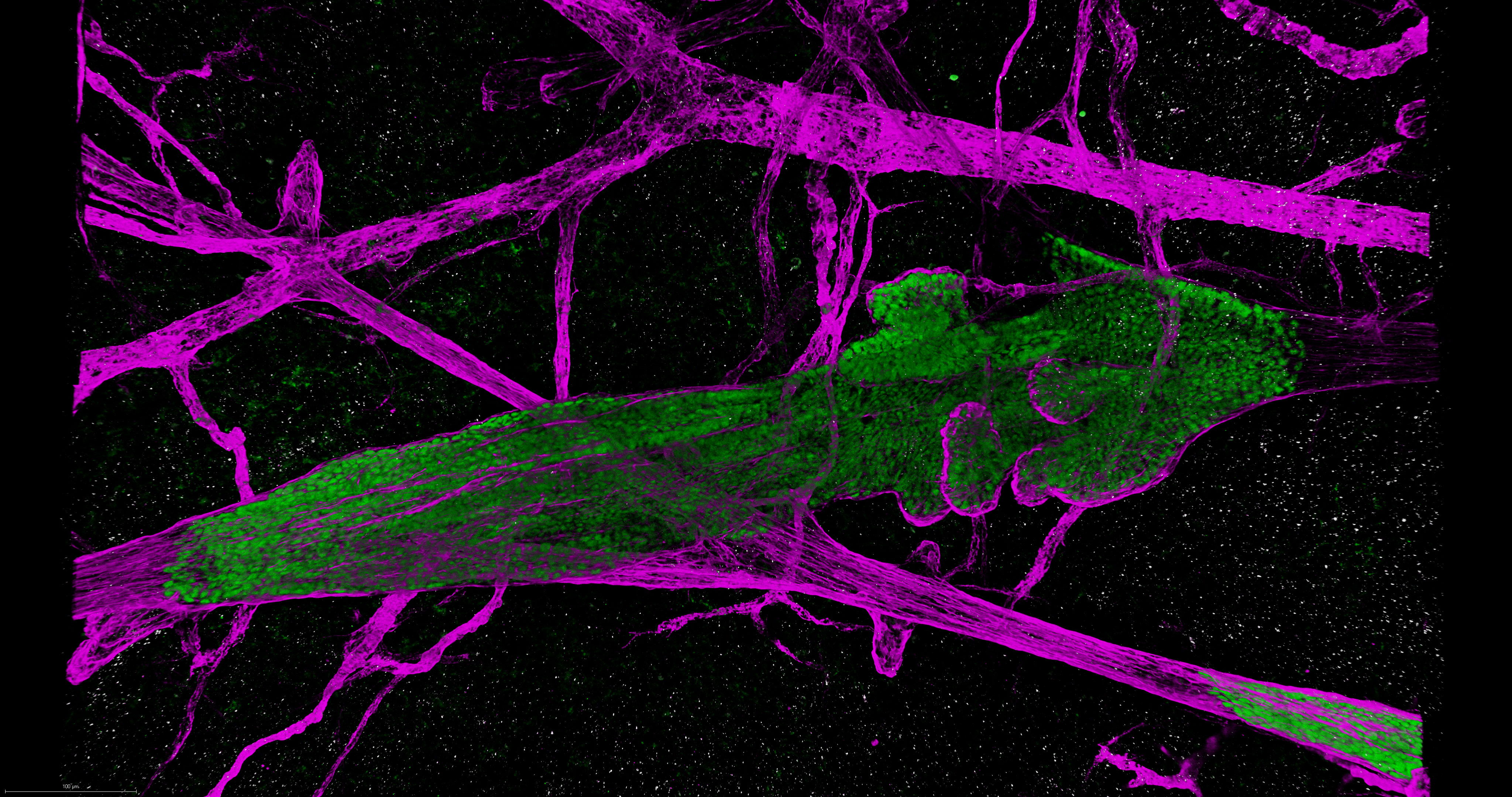Replacement growth of DCIS cells (green) in murine breast epithelium (purple)