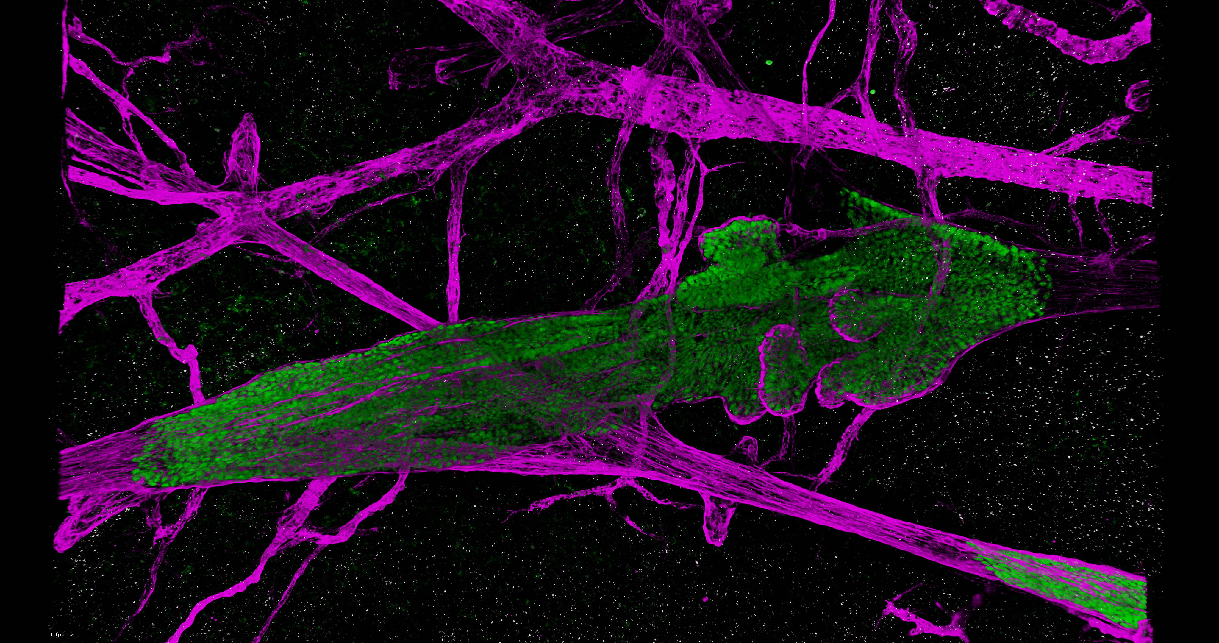 Replacement growth of DCIS cells (green) in murine breast epithelium (purple)