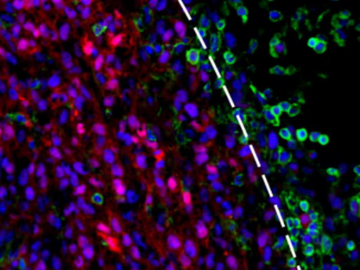 Natural killer cells may block cancer immunotherapy, Belgian study finds