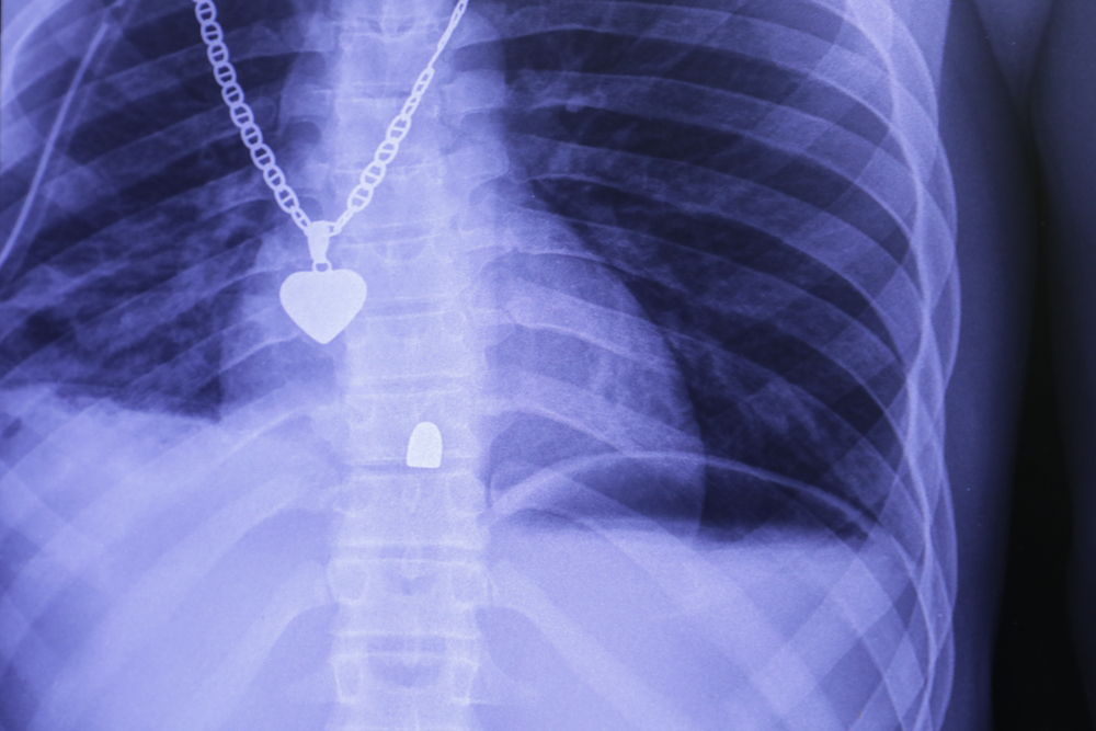 Radiografía del tórax de un paciente herido de un disparo con pistola y atendido en el nuevo hospital de MSF en Tabarre. La bala se alojó en la columna vertebral. © Nicolas Guyonnet/MSF