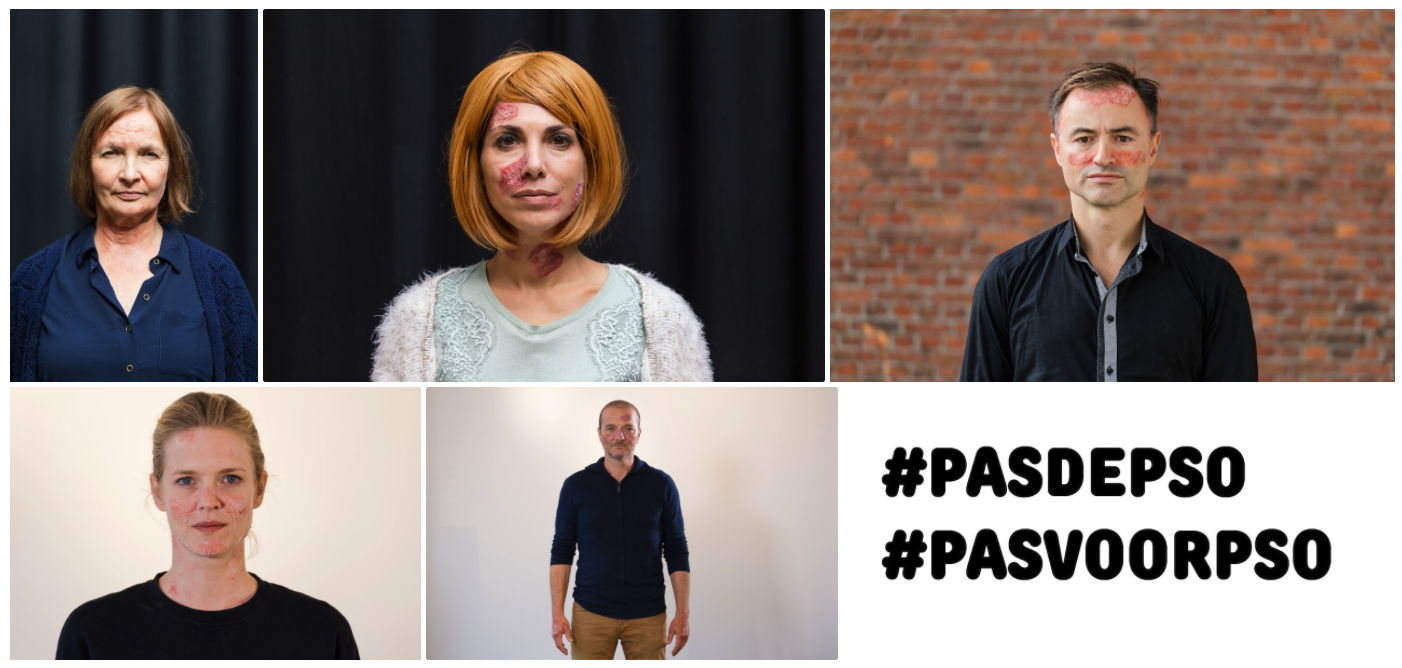 Lancering van de campagne #PasVoorPso: 5 Belgische psoriasispatiënten dagen 5 bekende mediafiguren uit om niet langer een pas te veel te zetten met deze huidziekte