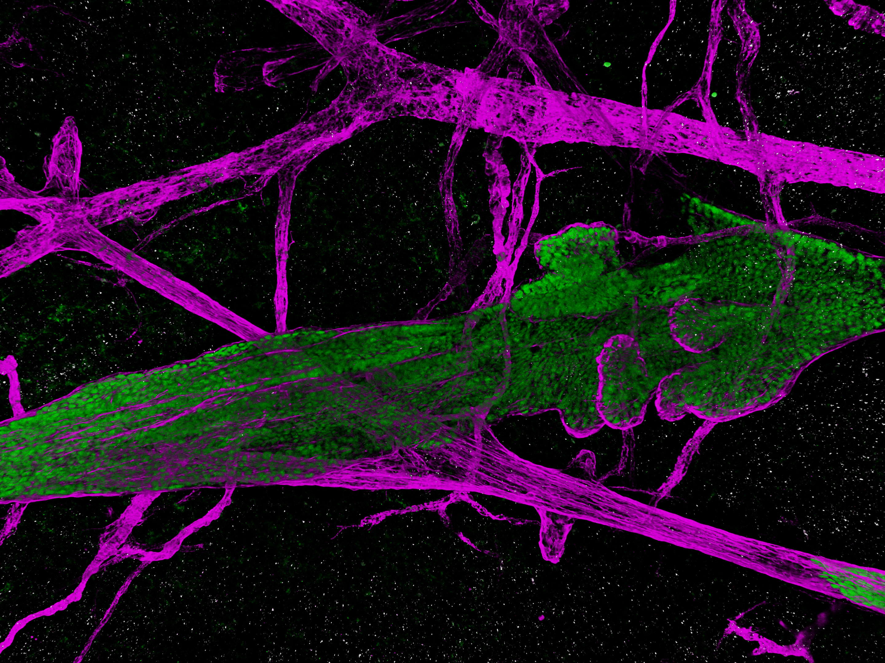 Precursor of breast cancer or not?