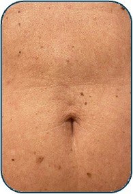 after abdomdem