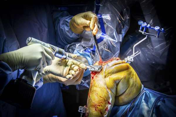 Eerste slimme operatierobot voor knieprotheses in Antwerpen
