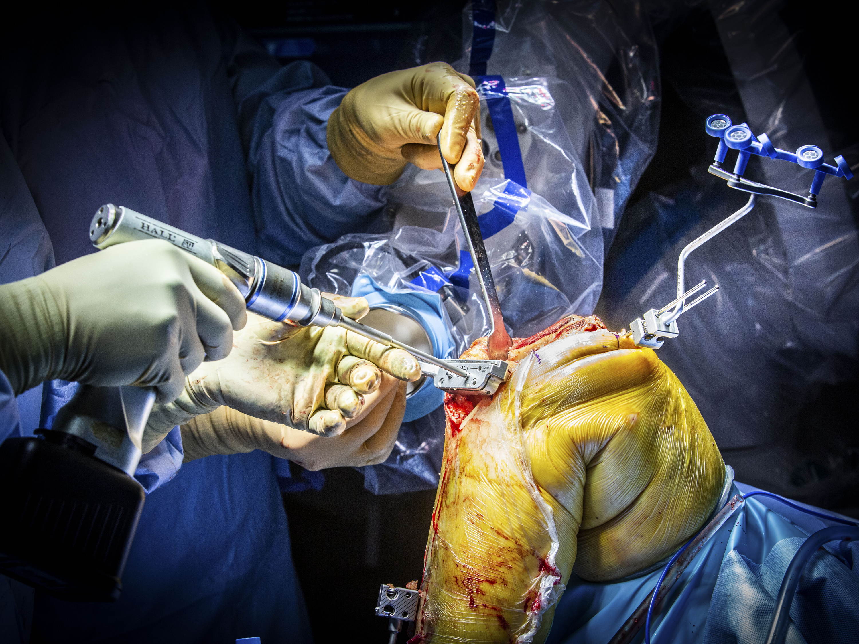 Eerste slimme operatierobot voor knieprotheses in Antwerpen