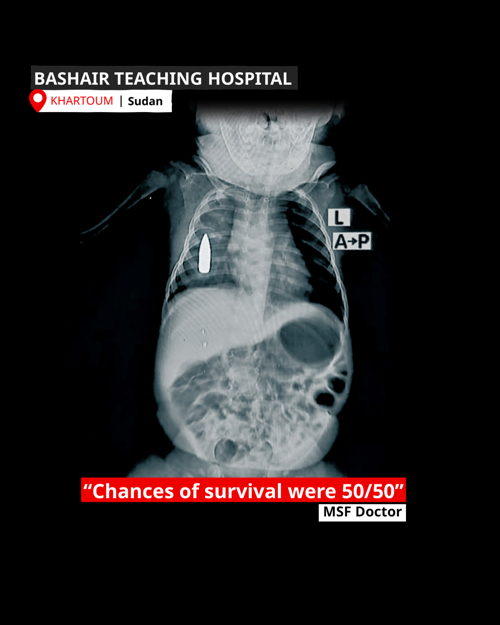 XRay of Baby Riyad. The 18-month-old toddler was struck in the chest by a stray bullet while he was taking a nap in Khartoum. Copyright: MSF